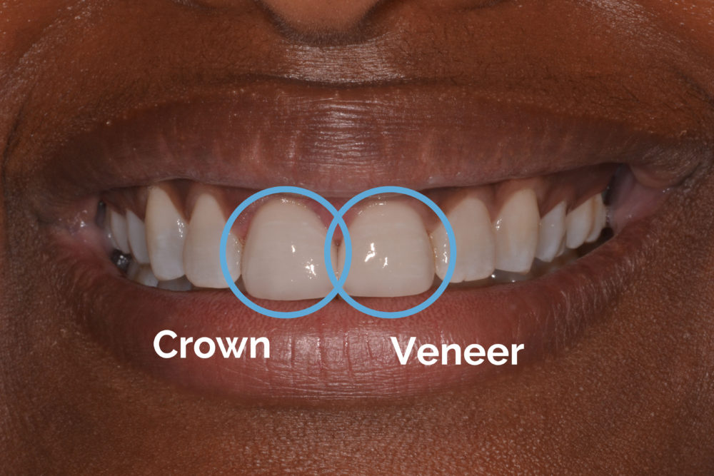Veneers vs. Crowns: What to Know