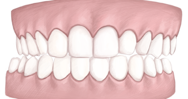 Crossbite