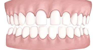 invisalign gapped teeth