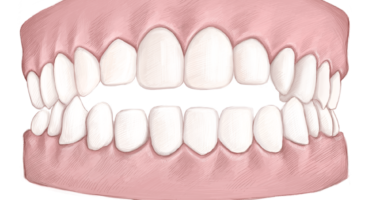 Open Bite
