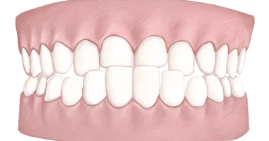 Underbite