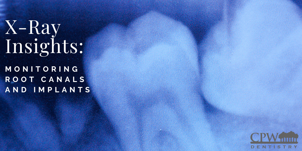 Dental x-ray image of teeth with overlaid text reading “X-Ray Insights: Monitoring Root Canals and Implants,” and CPW Dentistry logo in the bottom right corner.