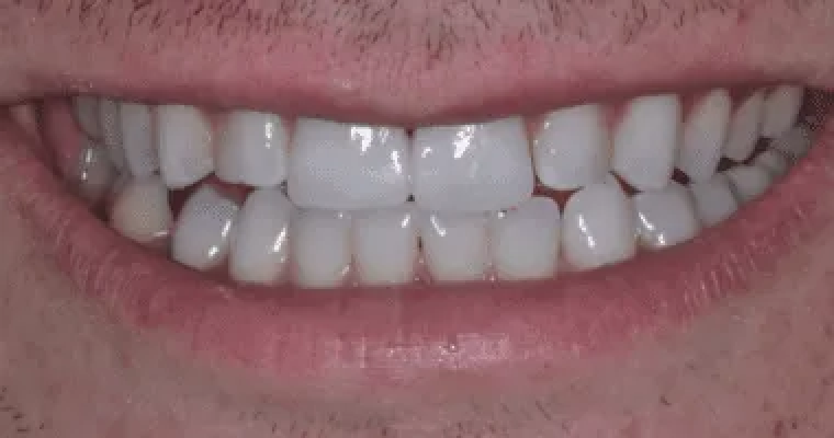 After. Same smile following cosmetic treatment. The gap between the front teeth has been closed, creating a smooth and continuous line across the upper teeth. The overall smile appears more even and cohesive.