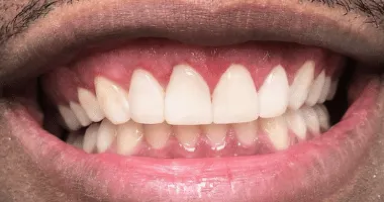 After. Same smile following cosmetic treatment. The upper teeth have been reshaped to appear longer, more even, and symmetrical. The gumline looks more balanced, and the teeth are smooth, bright, and uniform in color and shape.