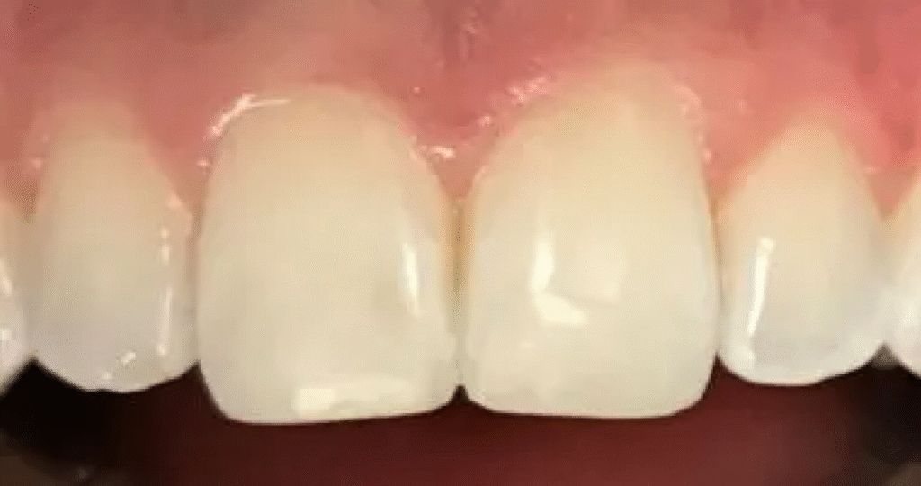 After. Same view following cosmetic repair. The chipped tooth has been smoothed and rebuilt to match the right front tooth. The incisal edges are now even and natural-looking, with a clean, symmetrical finish.