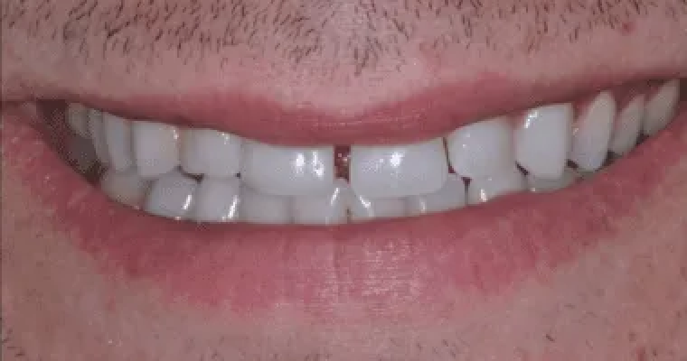 Before. Close-up of a smile showing a visible gap between the two upper front teeth (teeth #8 and #9). The spacing is noticeable when smiling, creating a break in the center of the upper arch.