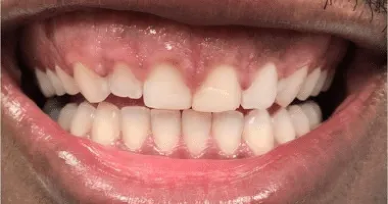 Before. Close-up of a smile showing noticeable wear and irregular edges on the upper front teeth. Several teeth appear shorter and more translucent near the tips, and the gumline shows some variation in height.
