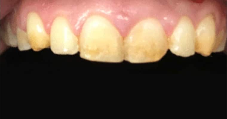 Before. Close-up of upper front teeth showing yellow discoloration and surface staining on multiple teeth. The enamel appears uneven in color, with visible wear and dark patches.