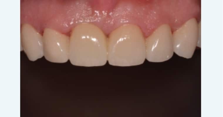 After. Same view after treatment. The gap between the front teeth has been fully closed, and the edges have been refined. The front teeth now appear smooth, symmetrical, and well-aligned with the rest of the smile.