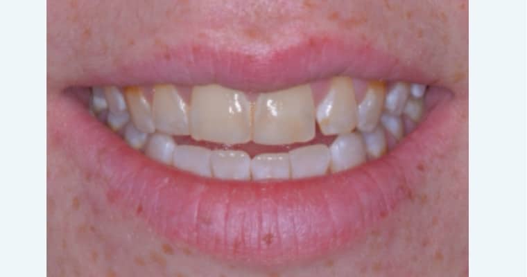 Before. Close-up of a smile showing yellow discoloration across the upper and lower teeth. The front teeth appear slightly uneven in tone, with staining that gives a dull appearance to the overall smile.