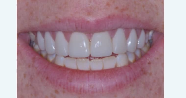 After. Same smile following cosmetic treatment. The teeth are visibly brighter and more even in color, with a clean, polished look that enhances the natural shape and alignment of the smile.