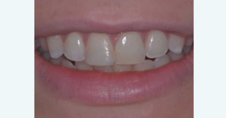 After. Same smile after treatment. The chipped tooth has been restored, and both front teeth now appear even and smooth. The repaired tooth matches the other in color and contour, giving the smile a natural, balanced look.