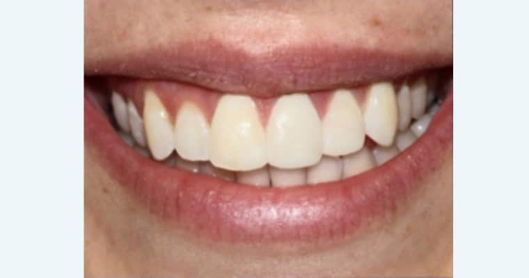 After. Same smile after repair. The chipped teeth have been restored in shape and length. The edges are smooth and even, and the overall smile looks natural and unbroken.