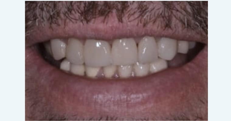 After: Same smile after treatment. The front tooth has been rebuilt and evened out. The new shape restores symmetry.