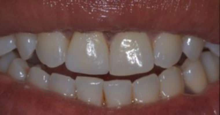 After. Same smile following treatment. The chipped tooth has been rebuilt to match the left front tooth in shape and length. The edges are smooth and even, and the front teeth now appear symmetrical and natural.