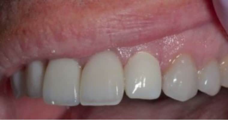 After. Same smile after restorative treatment. The previously chipped and discolored tooth has been rebuilt and brightened to match the surrounding teeth. The shape is smooth and consistent, creating a uniform and natural-looking smile.