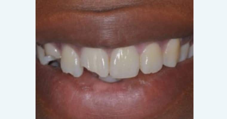 Before. Close-up of a smile showing major fractures in both front teeth (teeth #8 and #9). The right front tooth has a deep, jagged chip on the lower edge, while the left front tooth also has a visible break, creating a sharp and uneven appearance.