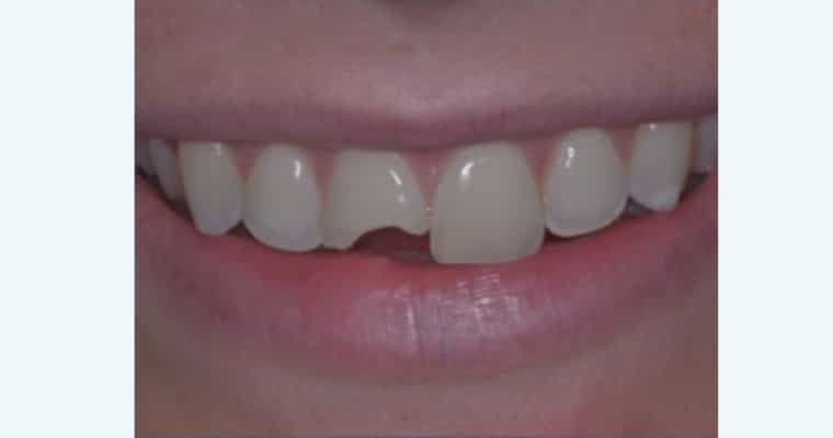 Before. Close-up of a smile showing a large chip in the bottom edge of the right front tooth (tooth #8). The break is rounded and extends deep into the center of the tooth, creating a noticeable difference in shape compared to the left front tooth.