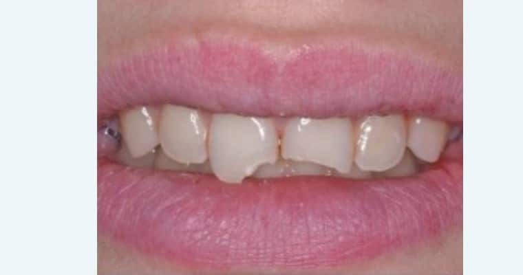 Before. Close-up of the upper front teeth. Two teeth each have a large, noticeable chip along the bottom edge, likely from an injury. The break is uneven and stands out against the rest of the smile.