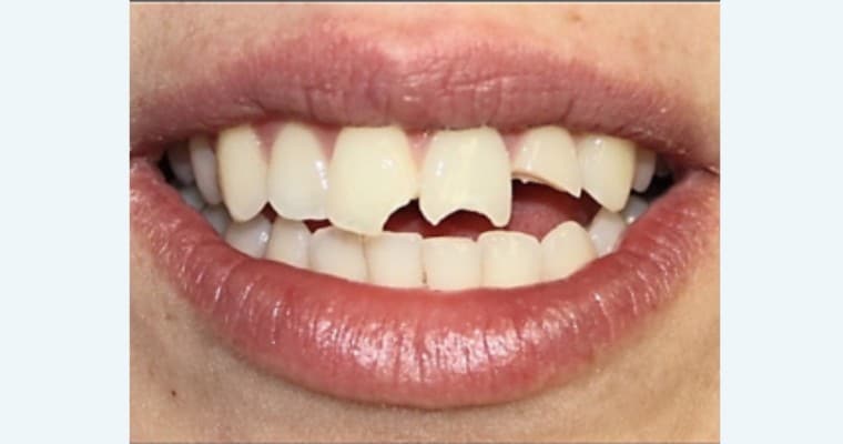 Before: Close-up of a smile showing large, sharp chips in three top, middle teeth. The breaks cuts into the center of the teeth.