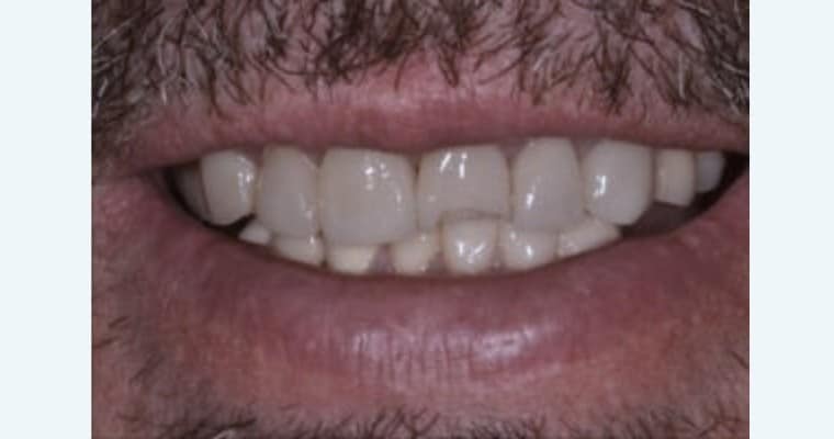 Before. Close-up of a smile showing a worn and uneven front tooth. An upper central incisor appears shorter and more translucent at the edges.