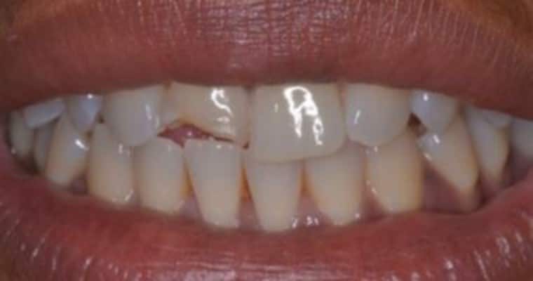 Before. Close-up of a smile showing a large chip in the lower half of the right front tooth (tooth #8). The break creates a deep, uneven notch in the tooth, with visible enamel loss and a noticeable contrast between the two front teeth.