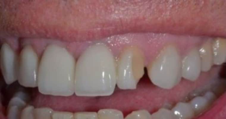 Before: Close-up of an upper side smile showing a large chip and discoloration on an upper tooth. The tooth appears darkened and misshapen, standing out from the neighboring teeth in both color and shape.