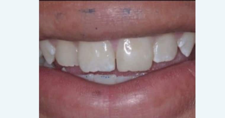 After. Same smile after dental restoration. The chipped left front tooth has been rebuilt to match the right one in length, shape, and color. It now appears even, smooth, and well-aligned with the rest of the smile.