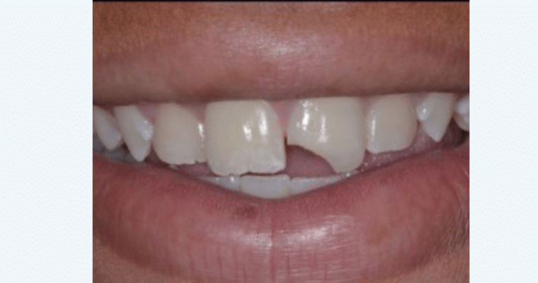 Before:Close-up of a smile showing a large, uneven break in the left front tooth (tooth #9). A significant portion of the bottom edge is missing, leaving a sharp, irregular gap.