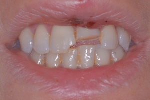 Before: Close-up of a smile showing severe chip on top, middle teeth.