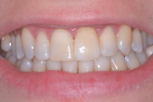 After. Same smile after restoration. The upper front teeth are now even, smooth, and bright, with healthy shape and color. The overall appearance is clean and natural.