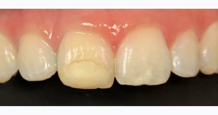 Before. Close-up of upper front teeth showing a visible chip and internal discoloration on the left central incisor (tooth #9). The chipped area appears worn and yellowed, with a rough, irregular surface that stands out from the adjacent teeth.