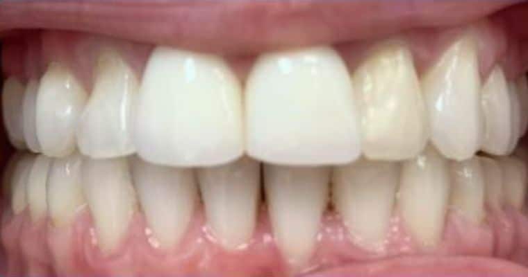 After. Same view after Invisalign treatment. The upper front teeth are now well-aligned with the midline centered, and all visible teeth appear straight and evenly spaced. The smile looks symmetrical and polished.