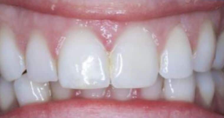 Before. Frontal view of the teeth showing a slight misalignment in the bite. The upper and lower front teeth don’t fully line up, with mild crowding and uneven contact between the arches when biting down.