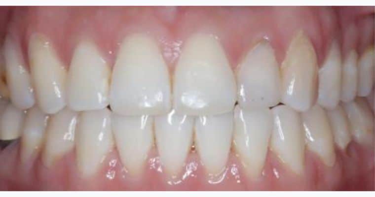 After. Same view after Invisalign treatment. The open bite has been fully corrected, with the upper and lower teeth now meeting evenly. The lower teeth are straighter, and the overall bite is more functional and symmetrical.