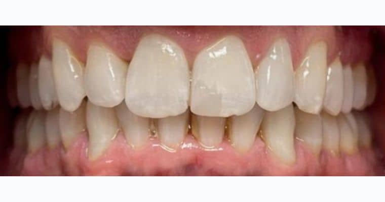 After. Same view following Invisalign treatment. The bite has been broadened, with improved alignment and natural overlap of the front teeth. The canines are more upright, and the overall arch appears fuller and more balanced.