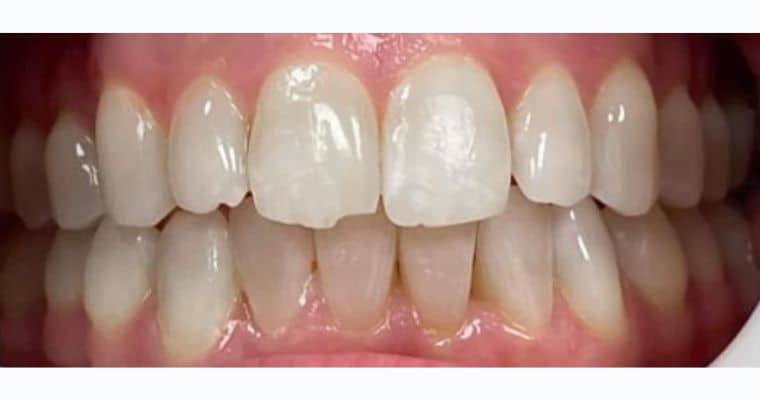 After. Same view after Invisalign treatment. The bite is now fully closed, with the upper and lower teeth meeting evenly. Crowding in the lower arch has been resolved, and the overall alignment and symmetry of the smile are significantly improved.