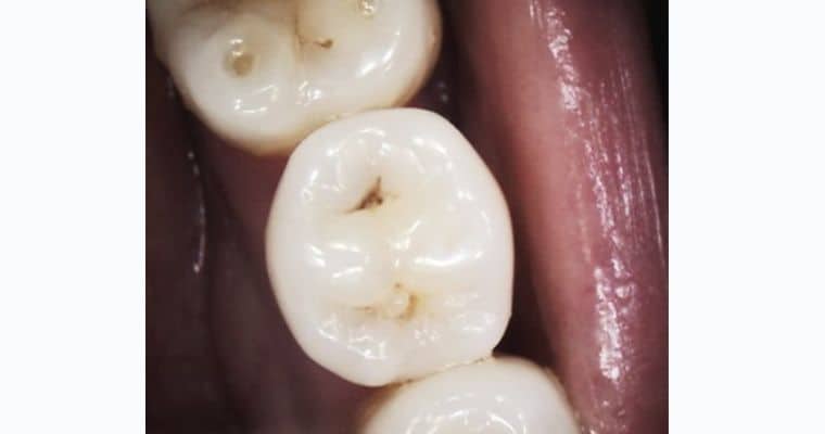 Before. Close-up of a molar with visible dark staining and early breakdown in the center grooves of the chewing surface. The tooth shows signs of wear and potential decay, with visible pits and discoloration.