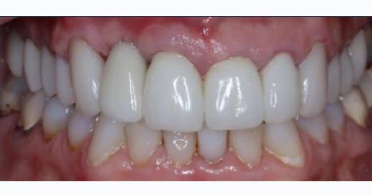 After. Same smile following implant treatment. The missing tooth has been replaced with a natural-looking dental implant that blends in seamlessly with the adjacent restorations. The upper arch now appears complete, even, and fully restored.