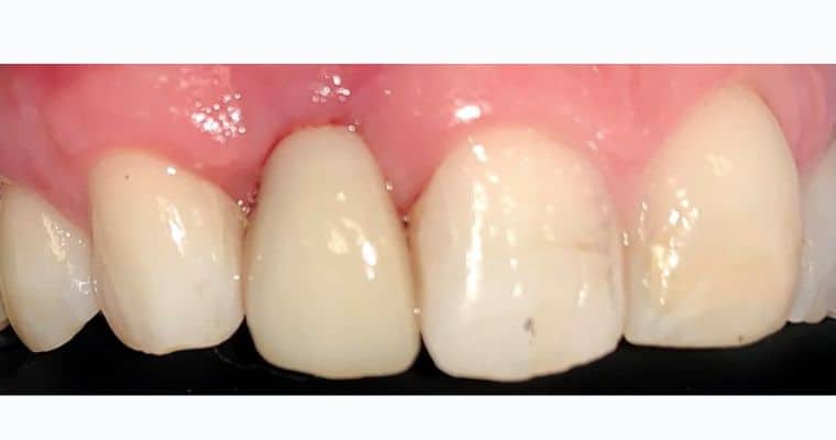 After. Same view after the implant crown has been placed. The missing tooth has been restored with a natural-looking crown that matches the shape and color of the neighboring teeth. The smile appears complete and the implant is no longer visible.