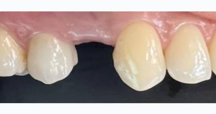 Before. Close-up of upper teeth showing a missing tooth in the middle of the arch. The gums have healed, leaving a visible gap between two natural teeth.