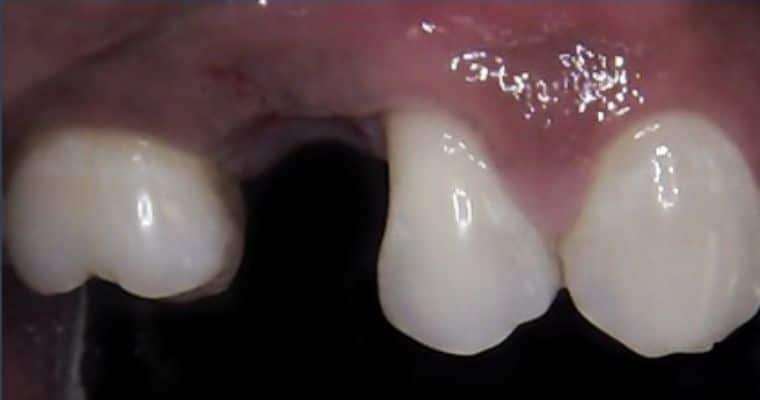 Before. Close-up of upper side teeth showing a visible gap where a tooth is missing. The gum tissue has healed, and the space is bordered by two natural teeth.