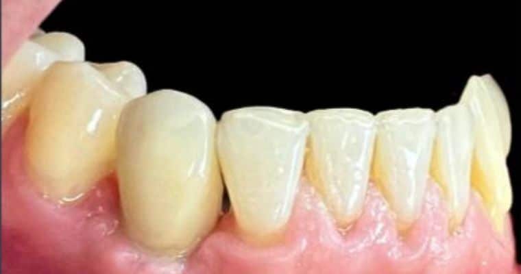 After. Same view after restoration. The missing molar has been replaced with a natural-looking tooth that fits seamlessly into the arch, restoring function and completing the smile.