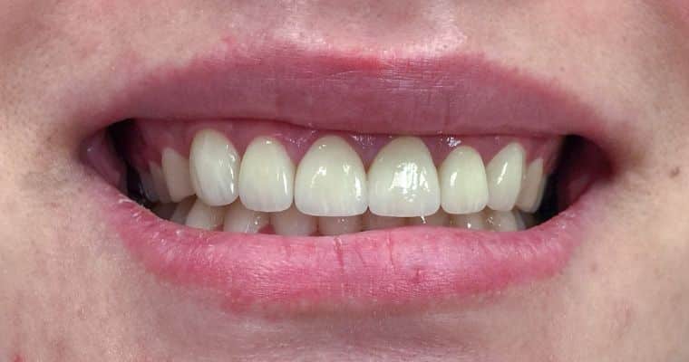 After. Same smile after cosmetic treatment. The teeth are significantly brighter and more uniform in color, with no visible staining and are even in length.