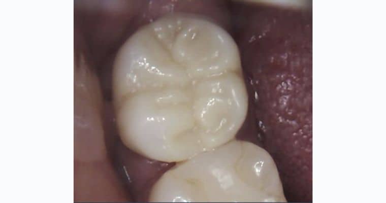 After. Same view after restorative treatment. The damaged molar has been fully rebuilt with a smooth, tooth-colored crown. The chewing surface is now intact and anatomically shaped, restoring both function and appearance.