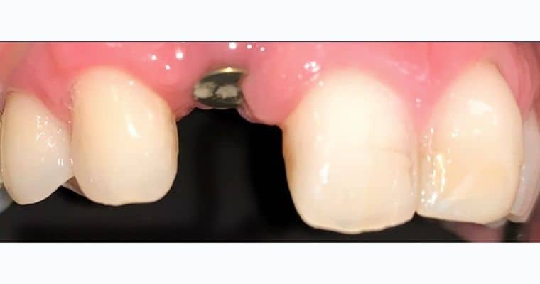 Before. Close-up of upper front teeth showing a missing tooth, with a visible metal implant post in the gums. The gap is noticeable and disrupts the line of the smile.