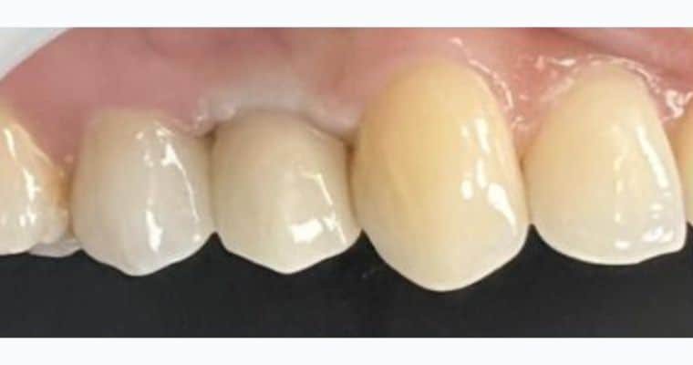After. Same view after treatment. The missing tooth has been replaced with a restoration that blends in naturally with the surrounding teeth in shape, size, and color. The arch now appears complete and even.