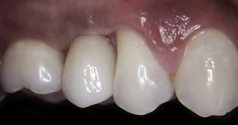 After. Same view after treatment. A natural-looking dental implant has been added to fill the gap, matching the color and shape of the surrounding teeth. The area now looks complete and healthy.