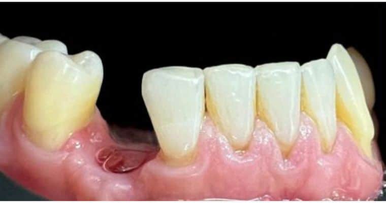 Before. Side view of the lower arch showing a missing molar near the back of the mouth. The gap is clearly visible, with gum tissue exposed where the tooth used to be.