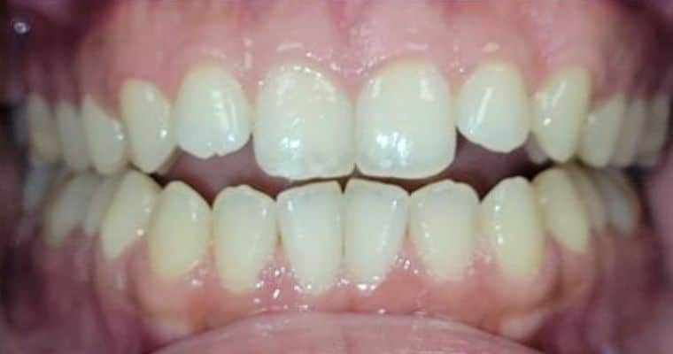 Before. Frontal view of the teeth showing a misaligned bite with an open space between the upper and lower front teeth when biting down. Several teeth appear slightly rotated or unevenly spaced, with visible gaps between top and bottom arches.
